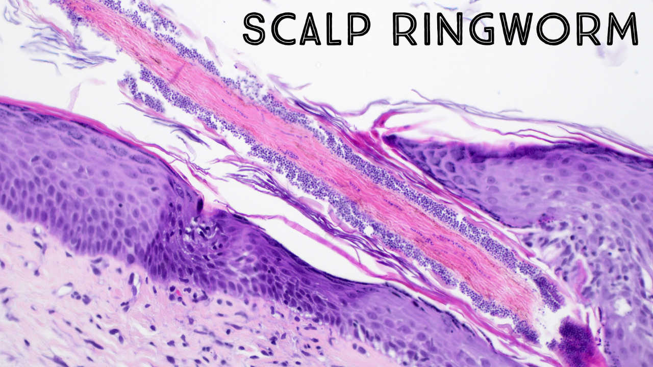Tinea capitis dermatophyte fungus in hair follicles endothrix